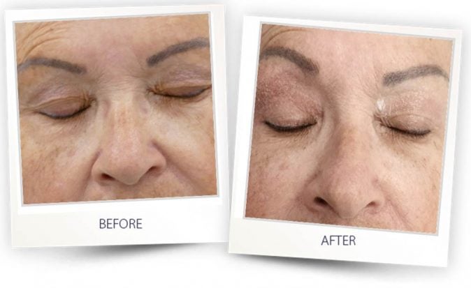 Colibre Before & After